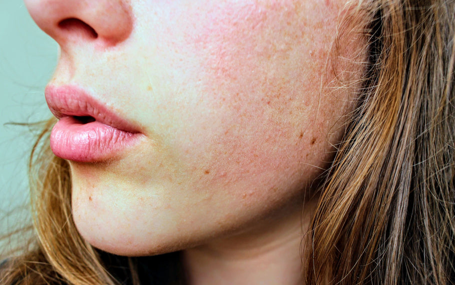 Rosacea: Do's and Don'ts